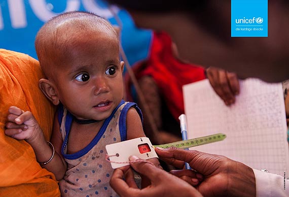 UNICEF: Katastrofalny wpyw pandemii na niedoywienie u dzieci. W 2020 r. roku ich liczba moe by najwysza w tym tysicleciu