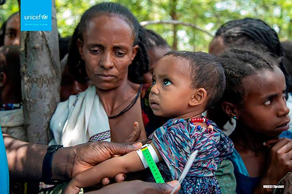 W pnocnej Etiopii liczba niedoywionych dzieci wzrosa dziesiciokrotnie, alarmuje UNICEF